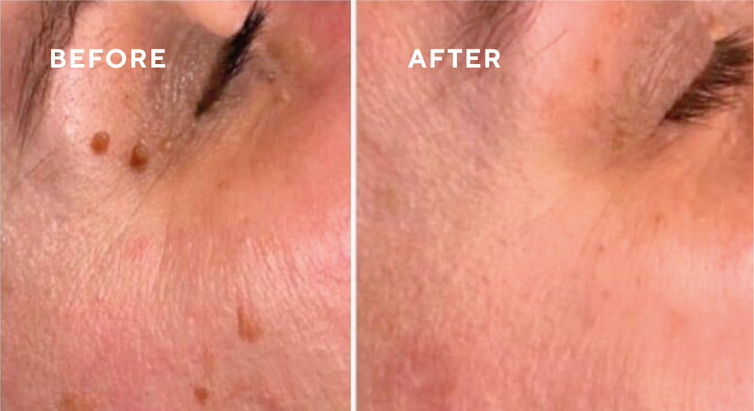 Cryopen Treatment and Map my Mole service in Berkshire