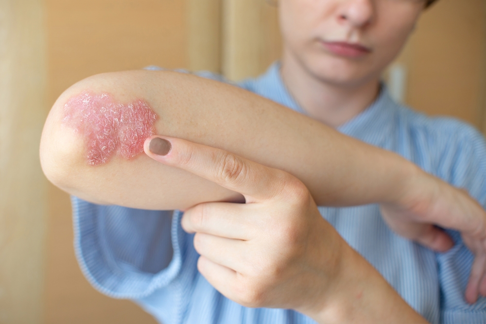 Psoriasis skin condition